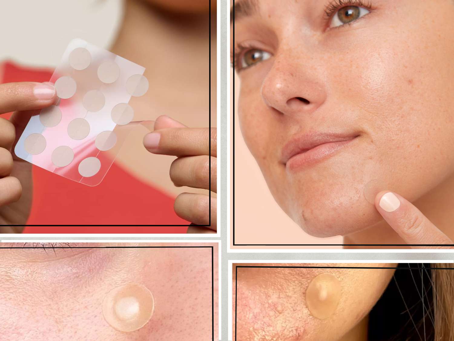 How Do Pimple Patches Work